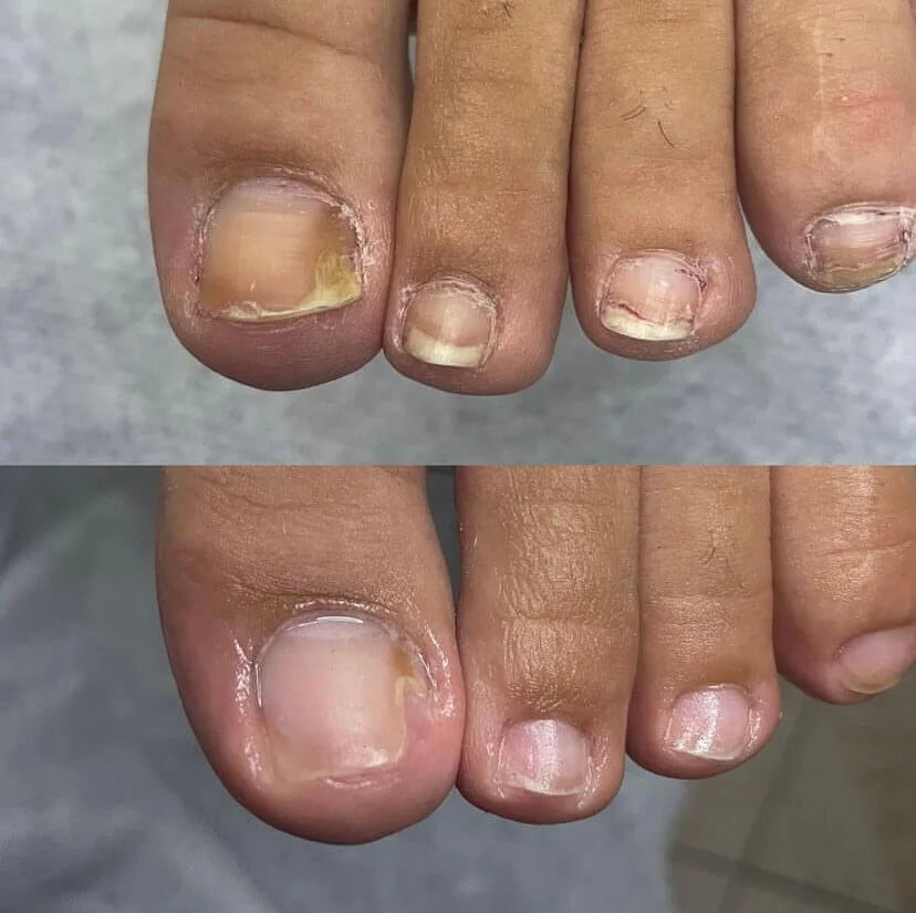 Comparison of fingernails before and after treatment on a person's hand.